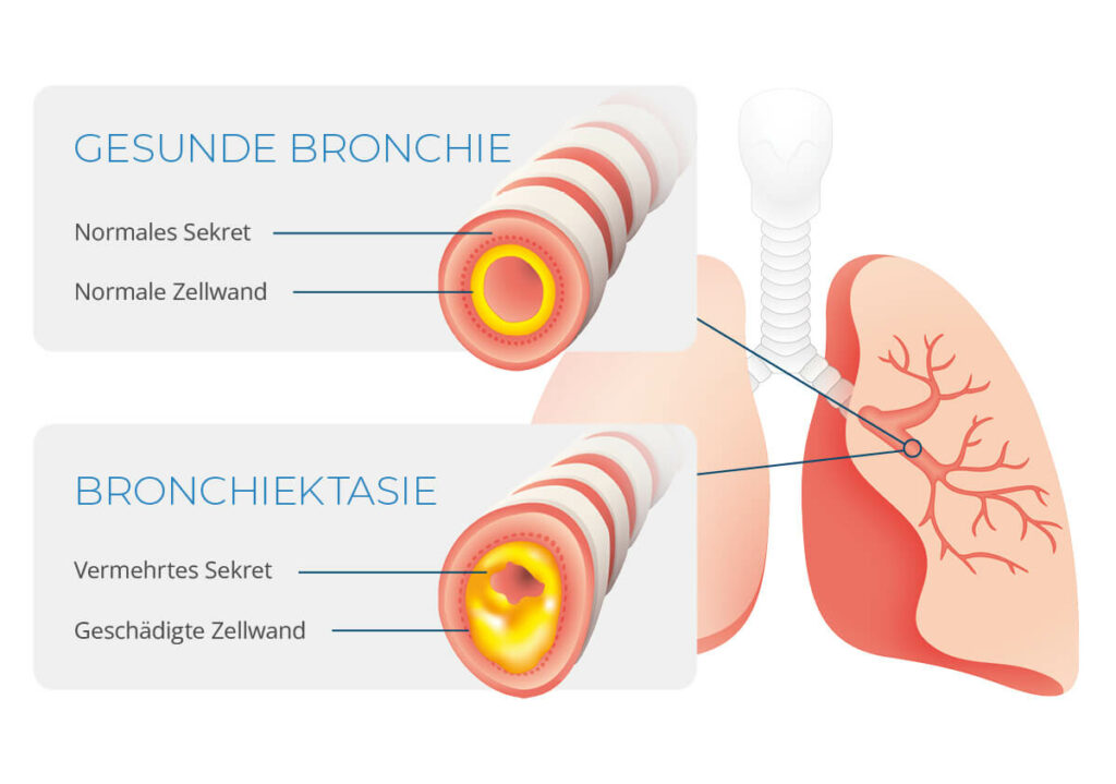 Bronchiektasen_was_sind_sie